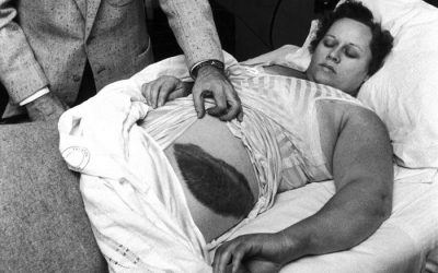 The First and Only Person in History To Be Hit by a Meteorite