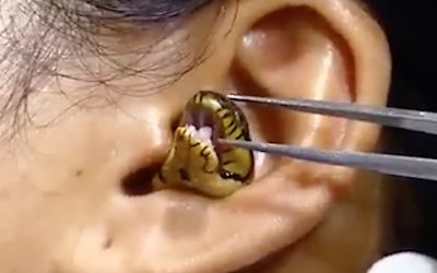 Video Of Live Snake Stuck In Woman’s Ear Goes Viral